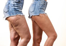 Can Aminophylline Reduce Cellulite